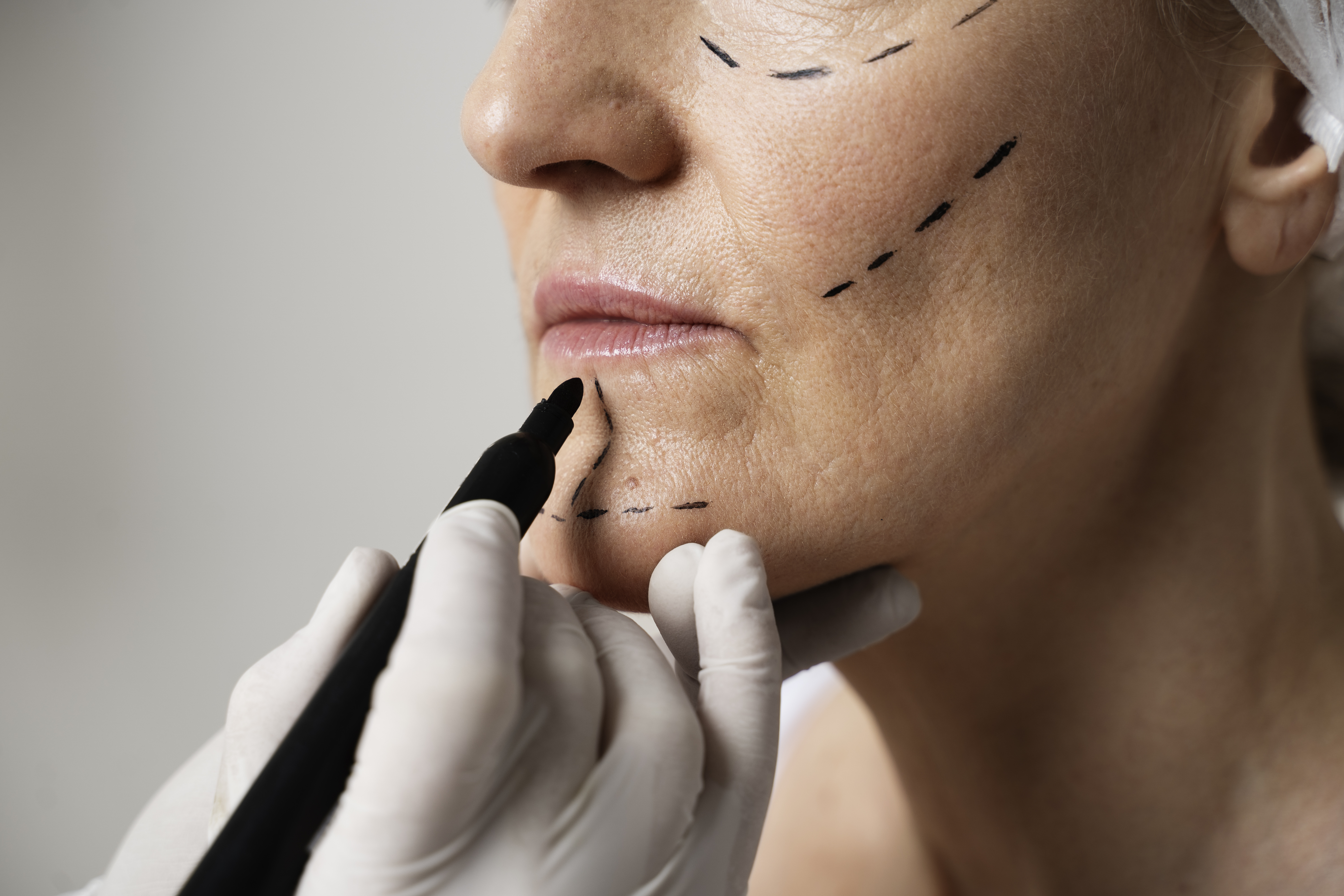 A women with surgical markings on her face