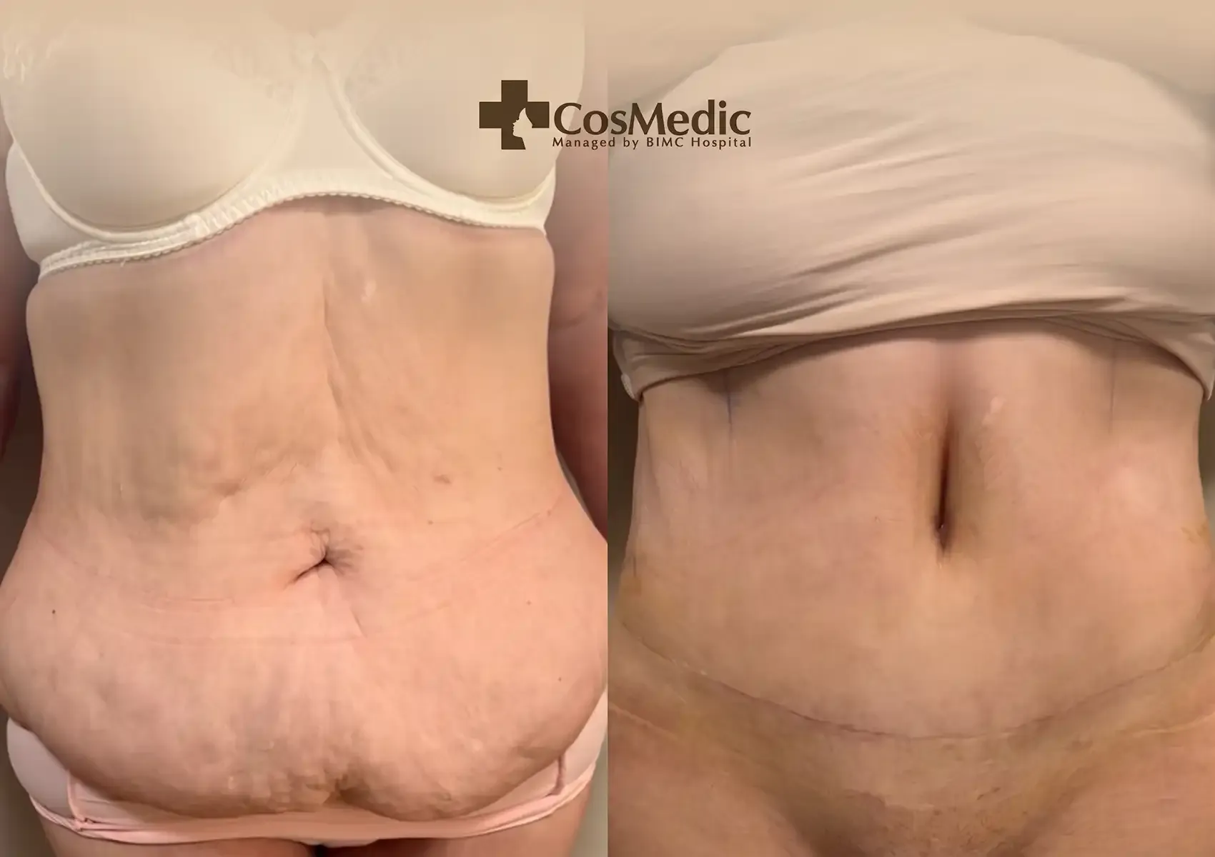 Before and after tummy tuck surgery showing abdominal skin tightening and incision placement at BIMC CosMedic Bali.