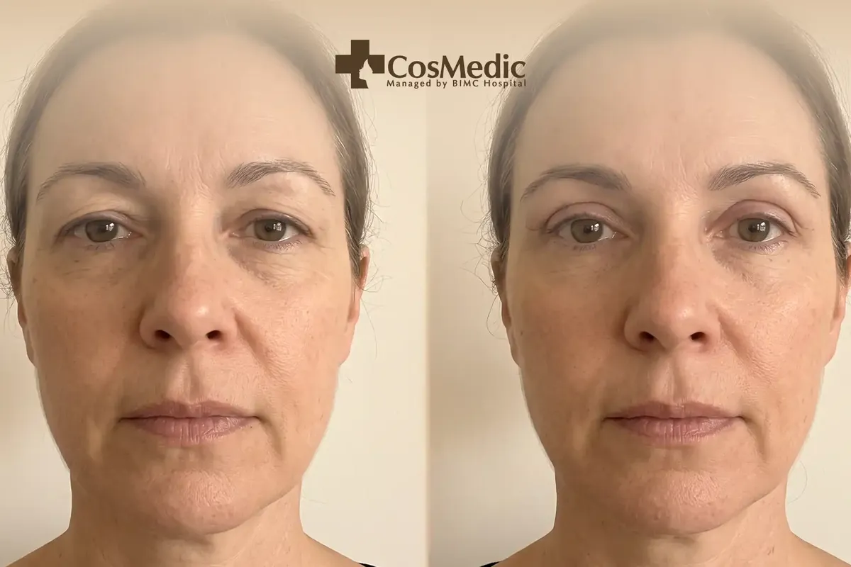 The Benefits of Upper Blepharoplasty