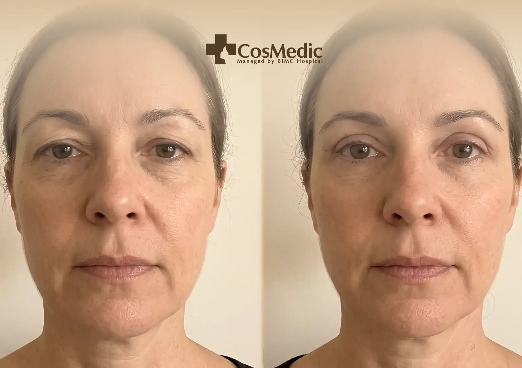 The Benefits of Upper Blepharoplasty