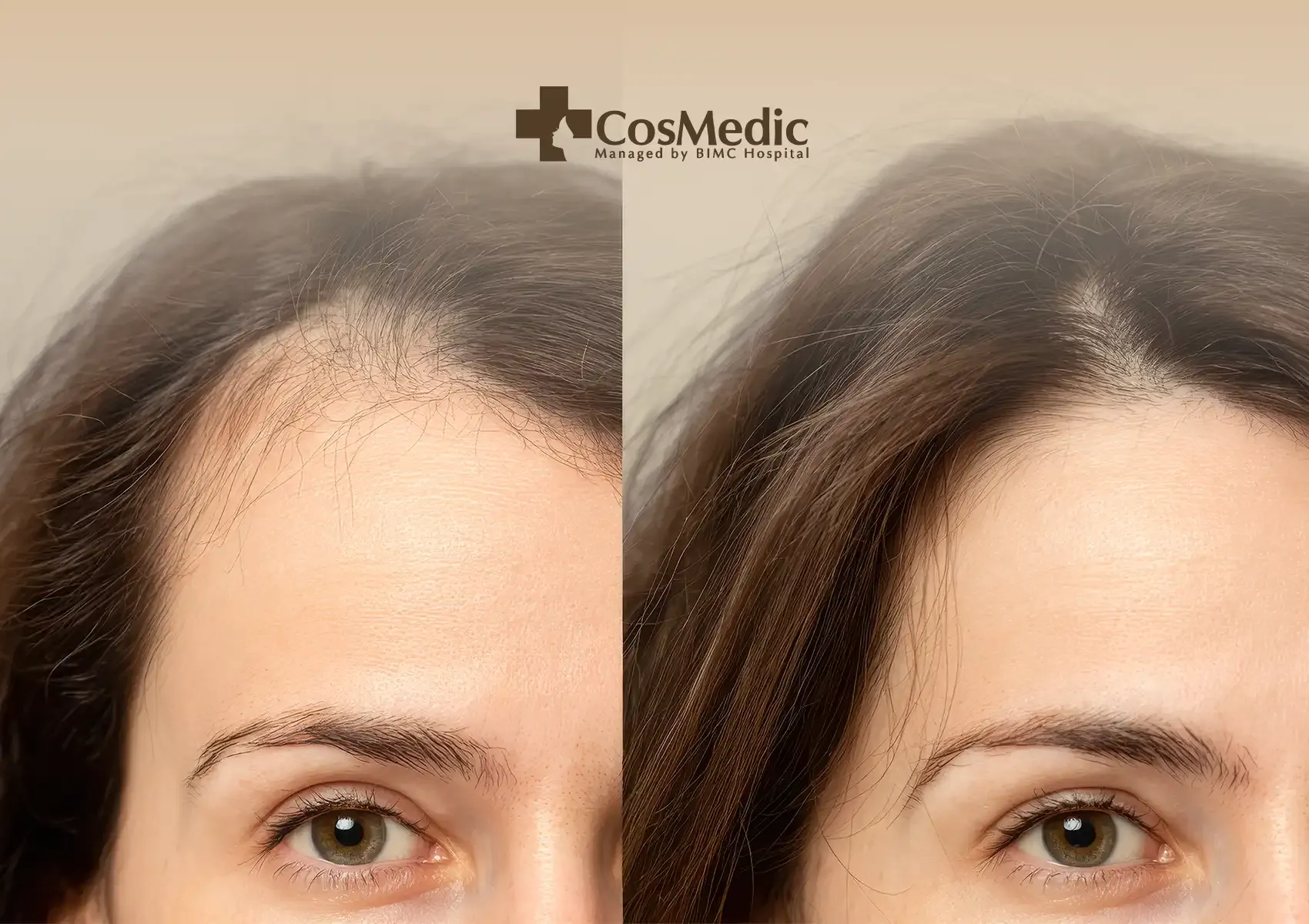 FUE Transplant Timeline and Recovery