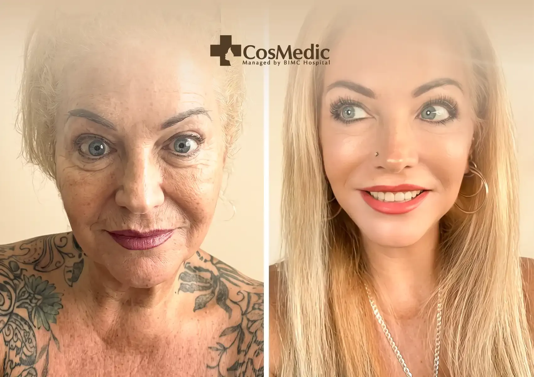 Before and after comparison of deep plane face and neck lift results showing natural facial rejuvenation.